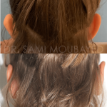 Source: Dr. Moubayed’s practice. Not a guarantee of results. Photos published with informed written consent of patients Young female treated with otoplasty in Montreal