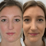 Source: Dr. Moubayed’s practice. Not a guarantee of results. Photos published with informed written consent of patients Female treated with ultrasonic rhinoplasty
