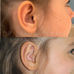 Source: Dr. Moubayed’s practice. Not a guarantee of results. Photos published with informed written consent of patients Young female treated with otoplasty in Montreal