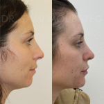 Source: Dr. Moubayed’s practice. Not a guarantee of results. Photos published with informed written consent of patients Female treated with ultrasonic rhinoplasty