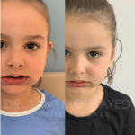 Source: Dr. Moubayed’s practice. Not a guarantee of results. Photos published with informed written consent of patients Young female treated with otoplasty in Montreal