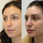 Source: Dr. Moubayed’s practice. Not a guarantee of results. Photos published with informed written consent of patients Female treated with ultrasonic rhinoplasty