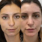 Source: Dr. Moubayed’s practice. Not a guarantee of results. Photos published with informed written consent of patients Female treated with ultrasonic rhinoplasty