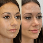 Source: Dr. Moubayed’s practice. Not a guarantee of results. Photos published with informed written consent of patients Female treated with ultrasonic rhinoplasty