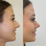 Source: Dr. Moubayed’s practice. Not a guarantee of results. Photos published with informed written consent of patients Female treated with ultrasonic rhinoplasty