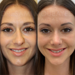 Source: Dr. Moubayed’s practice. Not a guarantee of results. Photos published with informed written consent of patients Female treated with ultrasonic rhinoplasty