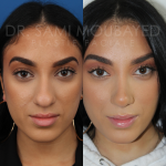 Source: Dr. Moubayed’s practice. Not a guarantee of results. Photos published with informed written consent of patients Middle Eastern female treated with rhinoplasty and alar base reductions