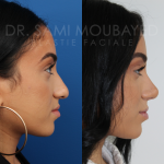 Source: Dr. Moubayed’s practice. Not a guarantee of results. Photos published with informed written consent of patients Middle Eastern female treated with rhinoplasty and alar base reductions