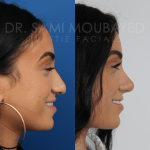 Source: Dr. Moubayed’s practice. Not a guarantee of results. Photos published with informed written consent of patients Middle Eastern female treated with rhinoplasty and alar base reductions