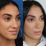Source: Dr. Moubayed’s practice. Not a guarantee of results. Photos published with informed written consent of patients Middle Eastern female treated with rhinoplasty and alar base reductions