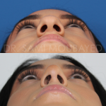 Source: Dr. Moubayed’s practice. Not a guarantee of results. Photos published with informed written consent of patients Middle Eastern female treated with rhinoplasty and alar base reductions