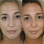 Source: Dr. Moubayed’s practice. Not a guarantee of results. Photos published with informed written consent of patients Middle Eastern female treated with septorhinoplasty