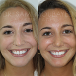 Source: Dr. Moubayed’s practice. Not a guarantee of results. Photos published with informed written consent of patients Middle Eastern female treated with septorhinoplasty