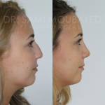 Source: Dr. Moubayed’s practice. Not a guarantee of results. Photos published with informed written consent of patients