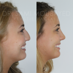 Source: Dr. Moubayed’s practice. Not a guarantee of results. Photos published with informed written consent of patients Middle Eastern female treated with septorhinoplasty