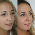 Source: Dr. Moubayed’s practice. Not a guarantee of results. Photos published with informed written consent of patients Middle Eastern female treated with septorhinoplasty