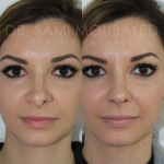 Source: Dr. Moubayed’s practice. Not a guarantee of results. Photos published with informed written consent of patients Female treated with rhinoplasty and alar base reductions