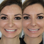 Source: Dr. Moubayed’s practice. Not a guarantee of results. Photos published with informed written consent of patients Female treated with rhinoplasty and alar base reductions