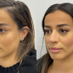 Source: Dr. Moubayed’s practice. Not a guarantee of results. Photos published with informed written consent of patients Middle Eastern female treated with ultrasonic septorhinoplasty