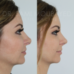 Source: Dr. Moubayed’s practice. Not a guarantee of results. Photos published with informed written consent of patients Female treated with rhinoplasty and alar base reductions
