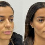 Source: Dr. Moubayed’s practice. Not a guarantee of results. Photos published with informed written consent of patients Middle Eastern female treated with ultrasonic septorhinoplasty