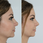 Source: Dr. Moubayed’s practice. Not a guarantee of results. Photos published with informed written consent of patients Female treated with rhinoplasty and alar base reductions