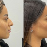 Source: Dr. Moubayed’s practice. Not a guarantee of results. Photos published with informed written consent of patients Middle Eastern female treated with ultrasonic septorhinoplasty