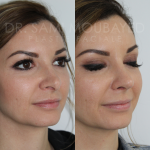 Source: Dr. Moubayed’s practice. Not a guarantee of results. Photos published with informed written consent of patients Female treated with rhinoplasty and alar base reductions