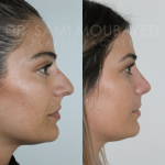 Source: Dr. Moubayed’s practice. Not a guarantee of results. Photos published with informed written consent of patients
