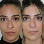 Source: Dr. Moubayed’s practice. Not a guarantee of results. Photos published with informed written consent of patients Female treated with rhinoplasty and alar base reductions