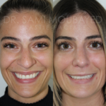 Source: Dr. Moubayed’s practice. Not a guarantee of results. Photos published with informed written consent of patients Female treated with rhinoplasty and alar base reductions