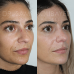 Source: Dr. Moubayed’s practice. Not a guarantee of results. Photos published with informed written consent of patients Female treated with rhinoplasty and alar base reductions