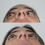 Source: Dr. Moubayed’s practice. Not a guarantee of results. Photos published with informed written consent of patients Female treated with rhinoplasty and alar base reductions