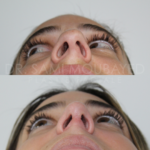 Source: Dr. Moubayed’s practice. Not a guarantee of results. Photos published with informed written consent of patients Female treated with rhinoplasty and alar base reductions