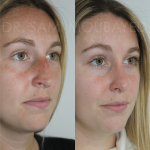 Source: Dr. Moubayed’s practice. Not a guarantee of results. Photos published with informed written consent of patients Female treated with rhinoplasty and alar base reductions