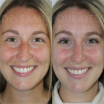 Source: Dr. Moubayed’s practice. Not a guarantee of results. Photos published with informed written consent of patients Female treated with rhinoplasty and alar base reductions