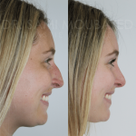 Source: Dr. Moubayed’s practice. Not a guarantee of results. Photos published with informed written consent of patients Female treated with rhinoplasty and alar base reductions