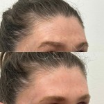 Beautiful relaxed, natural result after 1 neuromodulator session