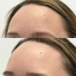 Beautiful results after one treatment only ro relax the muscles and rejuvenate the appearance of the skin