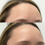 Beautiful results after one treatment only ro relax the muscles and rejuvenate the appearance of the skin