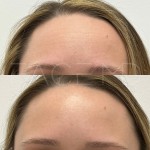 Beautiful results after one treatment only ro relax the muscles and rejuvenate the appearance of the skin