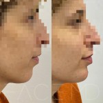Immediately after chin fillers at clinique Face MD