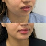 Subtle and beautiful result for facial harmonization with chin implant