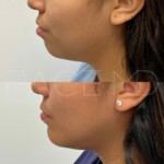 Chin implant result after 3.5 months for this beautiful patient