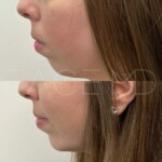 Beautiful natural result of chin implant on this patient
