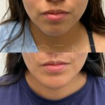 Chin implant result after 3.5 months for this beautiful patient