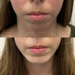 Beautiful natural result of chin implant on this patient
