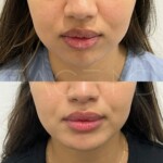 Subtle and beautiful result for facial harmonization with chin implant
