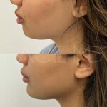 Subtle and beautiful result for facial harmonization with chin implant