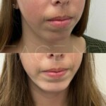Beautiful natural result of chin implant on this patient